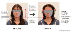 美容はりビフォーアフター2