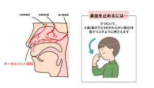 鼻血について